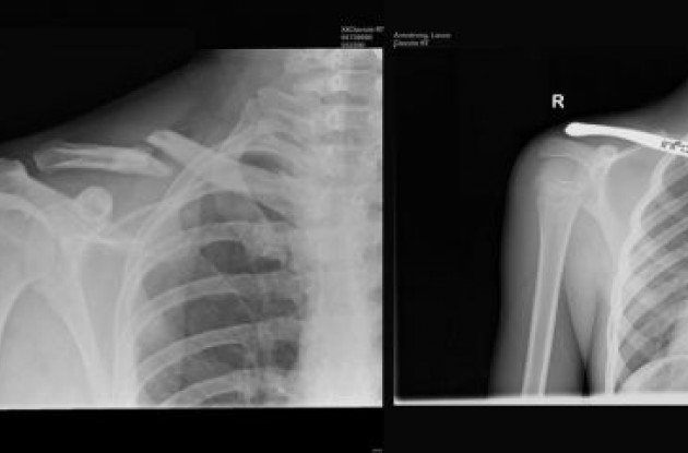X-Ray of Lance Armstrong's (Team Astana) fractured clavicle and the INFORM carbon clavicle implant after his recent surgery.