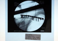 Photo of Team Astana's Lance Armstrong's clavicle / collarbone post-op. Photo by Elizabeth Kreutz courtesy of CSE.